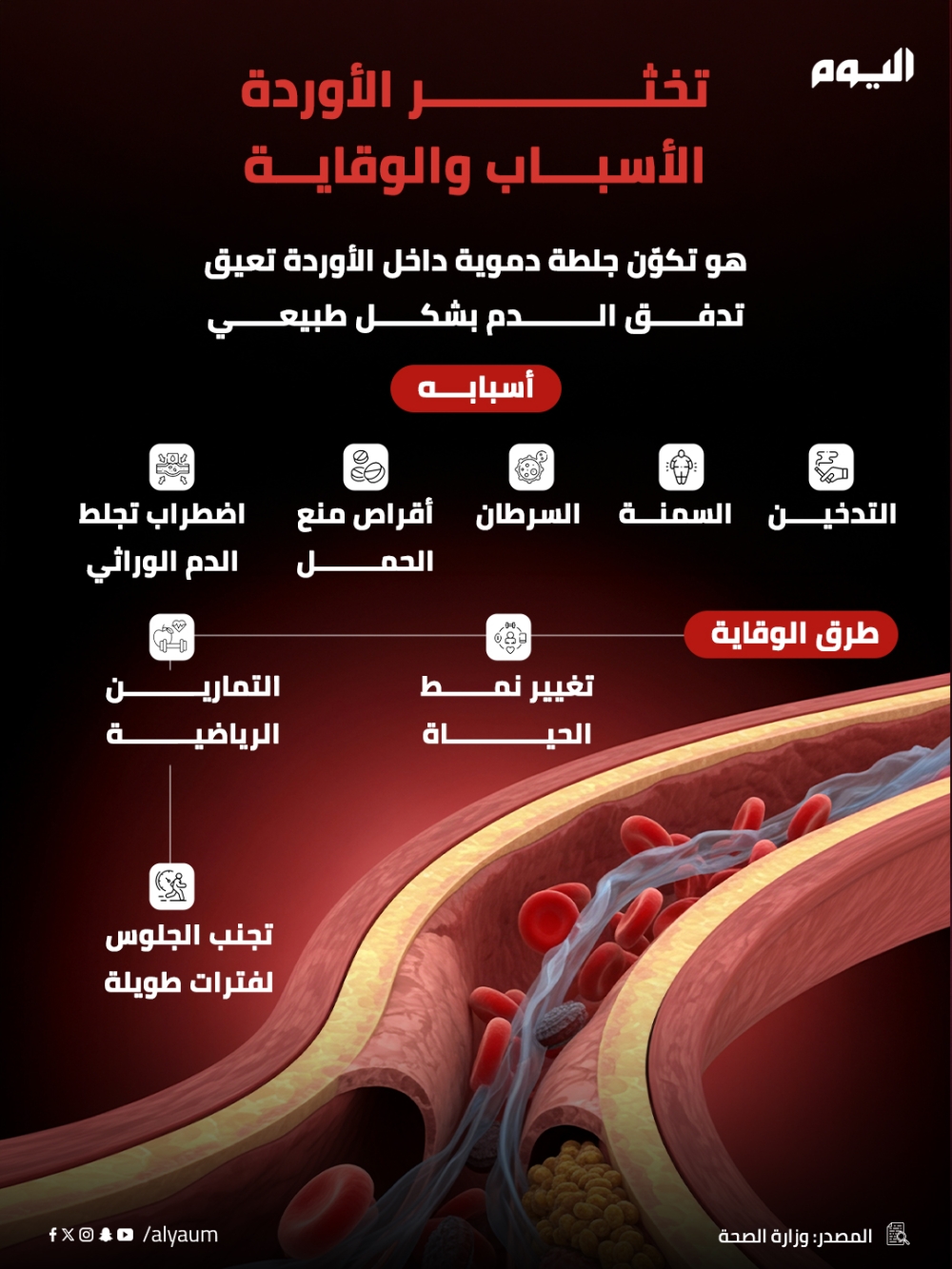تخثر الأوردة.. الأسباب والوقاية